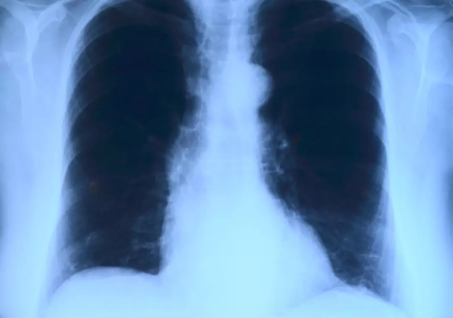 Symbolfoto auf 5min.at zeigt ein R&ouml;ntgenbild eines Brustkorbes.